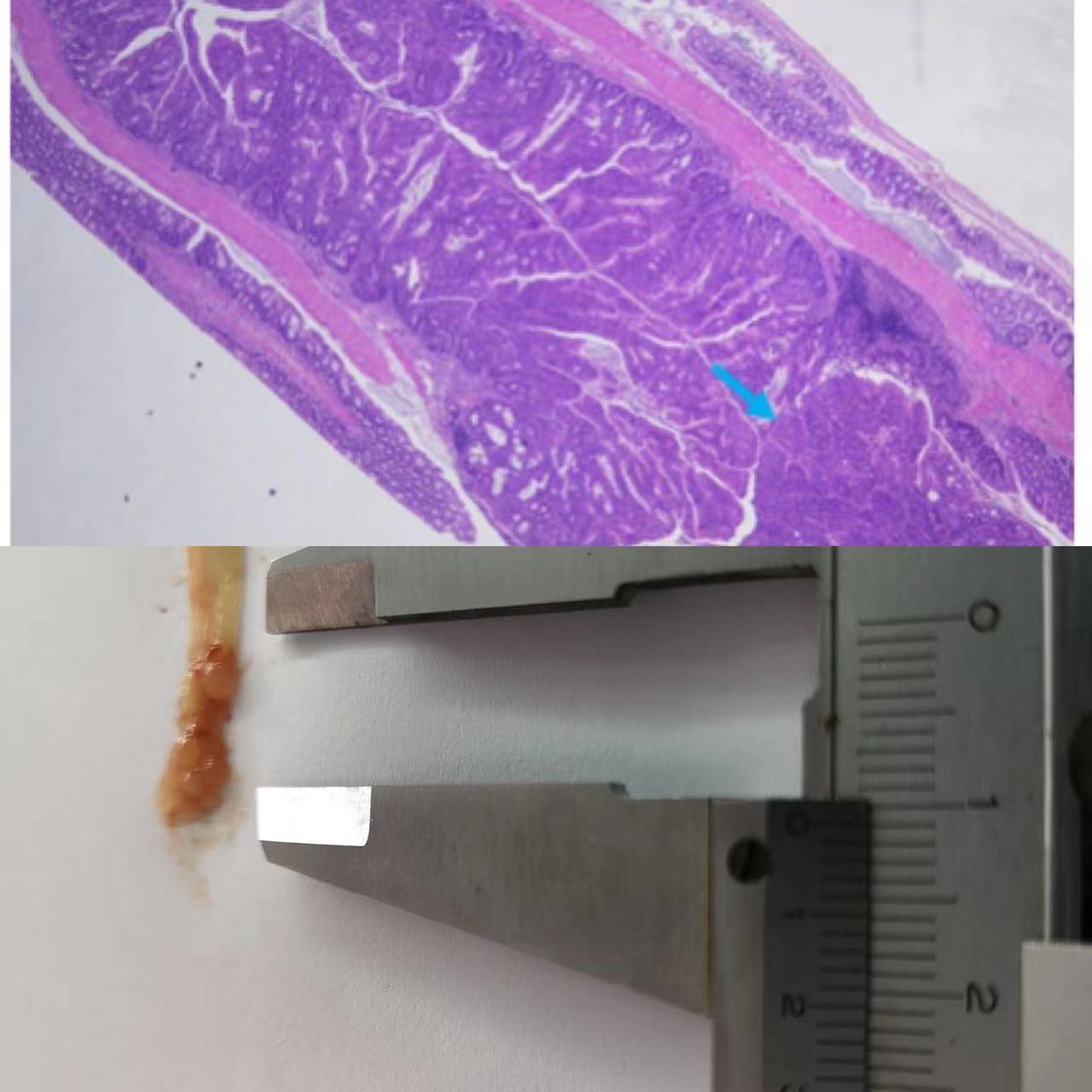诱导结直肠炎相关癌变模型构建(Ulcerative Co Litis Associatedcarcinogenesis,UCAC)